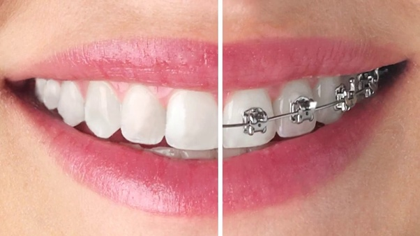 Braces Removal Process What Should You Expect - INSCMagazine