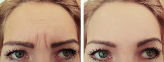 Anti-Wrinkle Injections
