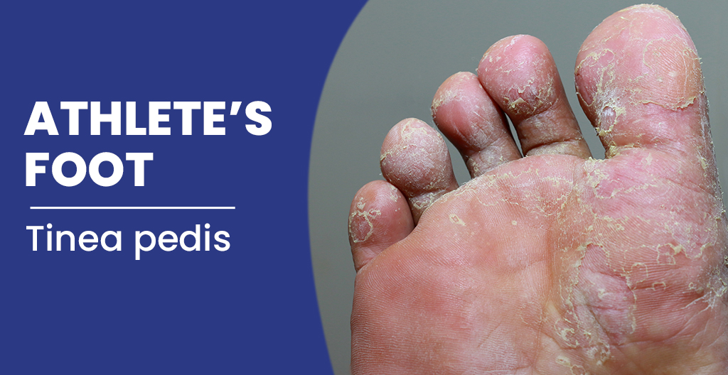 athlete-s-foot-causes-symptoms-treatment-inscmagazine