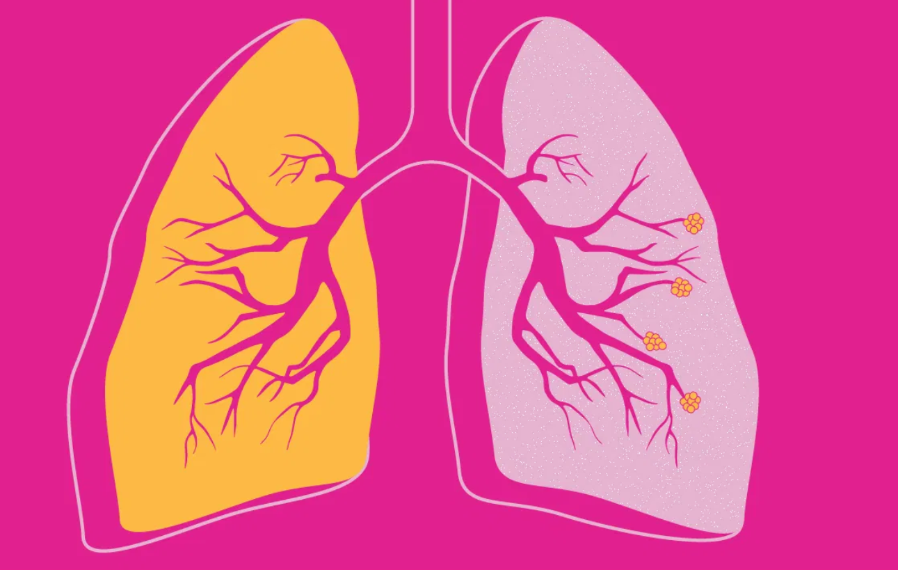 Transforming Respiratory Care: The Impact of Inhalation Devices with a ...