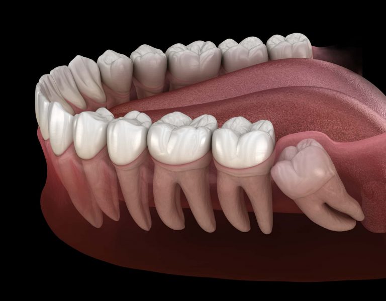 Understanding Wisdom Teeth: Causes, Complications, and Care - INSCMagazine