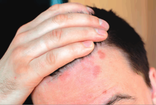 Seborrheic dermatitis